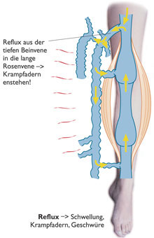 Reflux